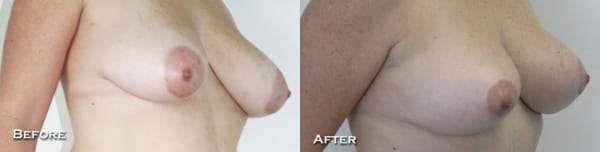 Breast Lift Before & After - Dr. Thomassen