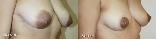 Breast Lift Before & After - Dr. Thomassen