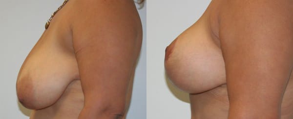 Breast Lift Before & After - Dr. Thomassen