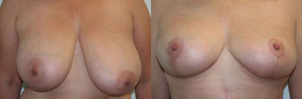 Breast Lift Before & After - Dr. Thomassen