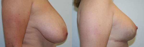 Breast Lift Before & After - Dr. Thomassen
