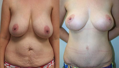 Breast Lift Before & After - Dr. Thomassen