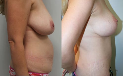 Breast Lift Before & After - Dr. Thomassen