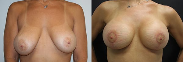 Breast Lift Before & After - Dr. Thomassen