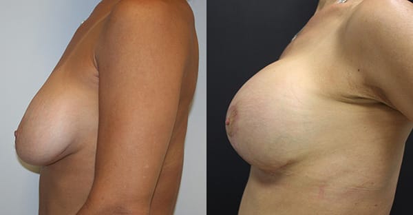 Breast Lift Before & After - Dr. Thomassen