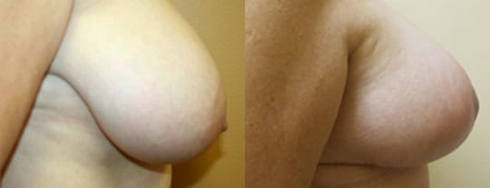 Breast Lift Before & After - Dr. Thomassen