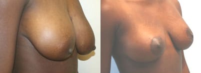 Breast Lift Before & After - Dr. Thomassen