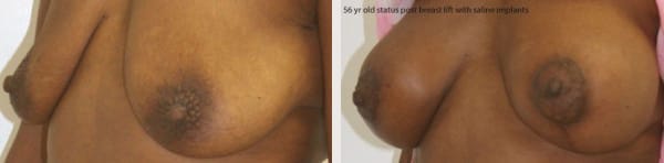 Breast Lift Before & After - Dr. Thomassen