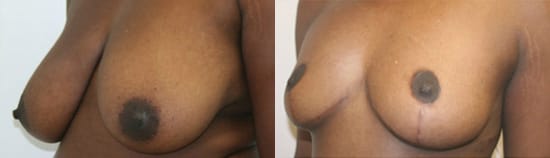 Breast Lift Before & After - Dr. Thomassen