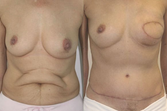 Breast Reconstruction Before & After - Dr. Thomassen