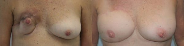 Breast Reconstruction Before & After - Dr. Thomassen