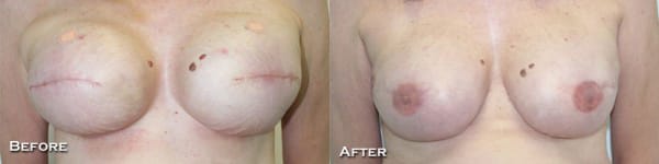 Breast Reconstruction Before & After - Dr. Thomassen
