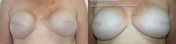 Breast Reconstruction Before & After - Dr. Thomassen