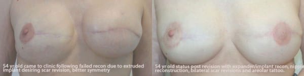 Breast Reconstruction Before & After - Dr. Thomassen