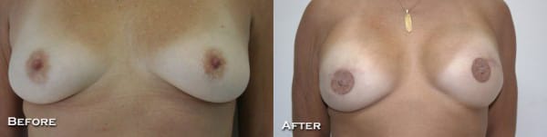 Breast Reconstruction Before & After - Dr. Thomassen