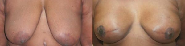 Breast Reconstruction Before & After - Dr. Thomassen