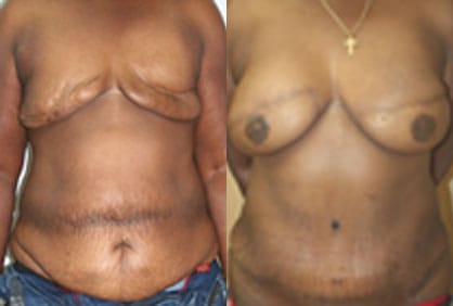 Breast Reconstruction Before & After - Dr. Thomassen