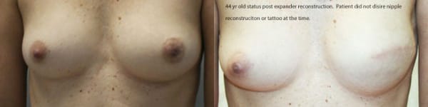 Breast Reconstruction Before & After - Dr. Thomassen
