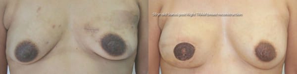 Breast Reconstruction Before & After - Dr. Thomassen