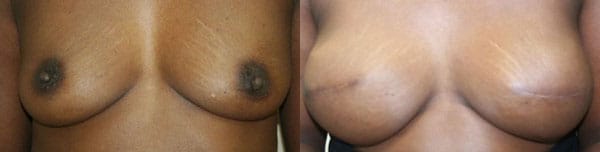 Breast Reconstruction Before & After - Dr. Thomassen
