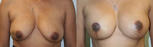 Breast Reconstruction Before & After - Dr. Thomassen