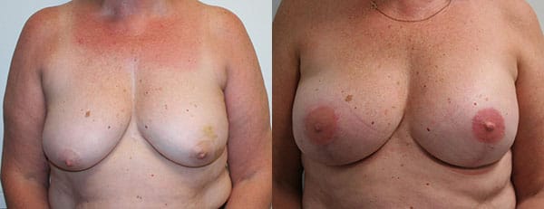 Breast Reconstruction Before & After - Dr. Thomassen