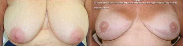 Breast Reconstruction Before & After - Dr. Thomassen