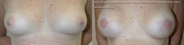 Breast Reconstruction Before & After - Dr. Thomassen