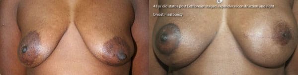 Breast Reconstruction Before & After - Dr. Thomassen