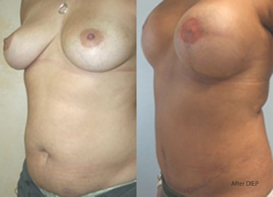 Breast Reconstruction Before & After - Dr. Thomassen