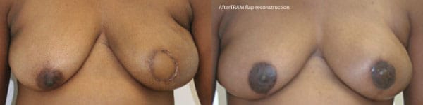 Breast Reconstruction Before & After - Dr. Thomassen