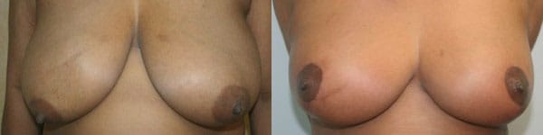 Breast Reduction Before & After - Dr. Thomassen