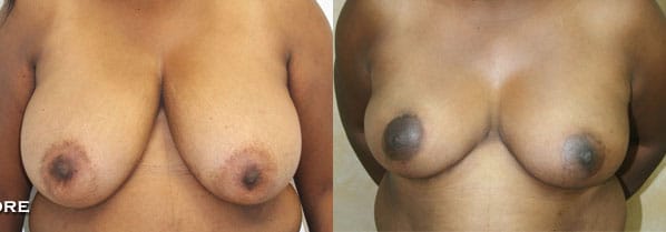 Breast Reduction Before & After - Dr. Thomassen