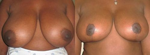 Breast Reduction Before & After - Dr. Thomassen