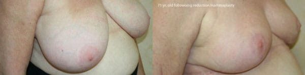 Breast Reduction Before & After - Dr. Thomassen