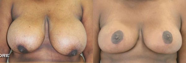 Breast Reduction Before & After - Dr. Thomassen