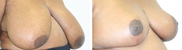 Breast Reduction Before & After - Dr. Thomassen
