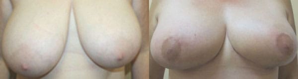Breast Reduction Before & After - Dr. Thomassen