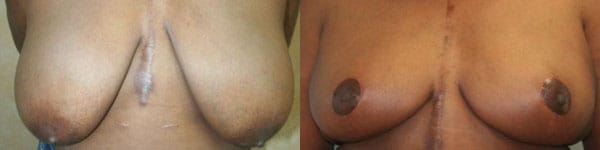 Breast Reduction Before & After - Dr. Thomassen