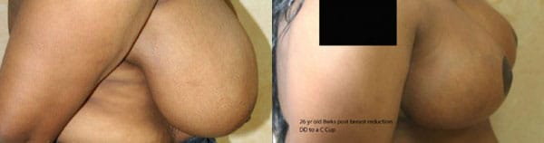 Breast Reduction Before & After - Dr. Thomassen