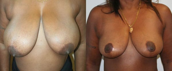Breast Reduction Before & After - Dr. Thomassen