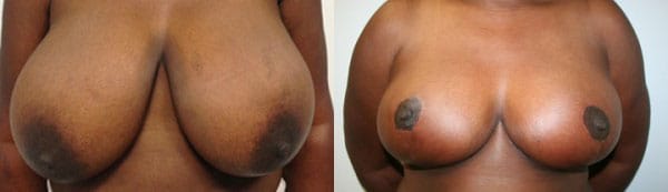 Breast Reduction Before & After - Dr. Thomassen