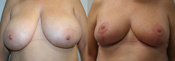 Breast Reduction Before & After - Dr. Thomassen