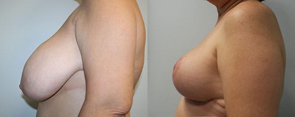 Breast Reduction Before & After - Dr. Thomassen