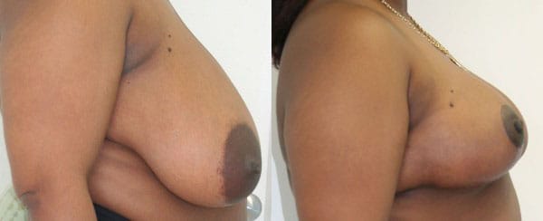 Breast Reduction Before & After - Dr. Thomassen