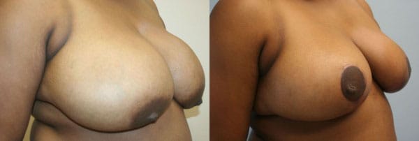 Breast Reduction Before & After - Dr. Thomassen