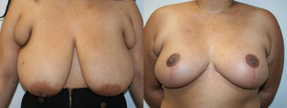Breast Reduction Before & After - Dr. Thomassen