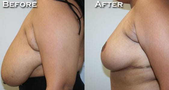 Breast Reduction Before & After - Dr. Thomassen