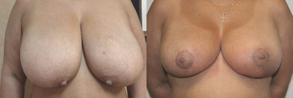 Breast Reduction Before & After - Dr. Thomassen