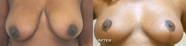 Breast Reduction Before & After - Dr. Thomassen